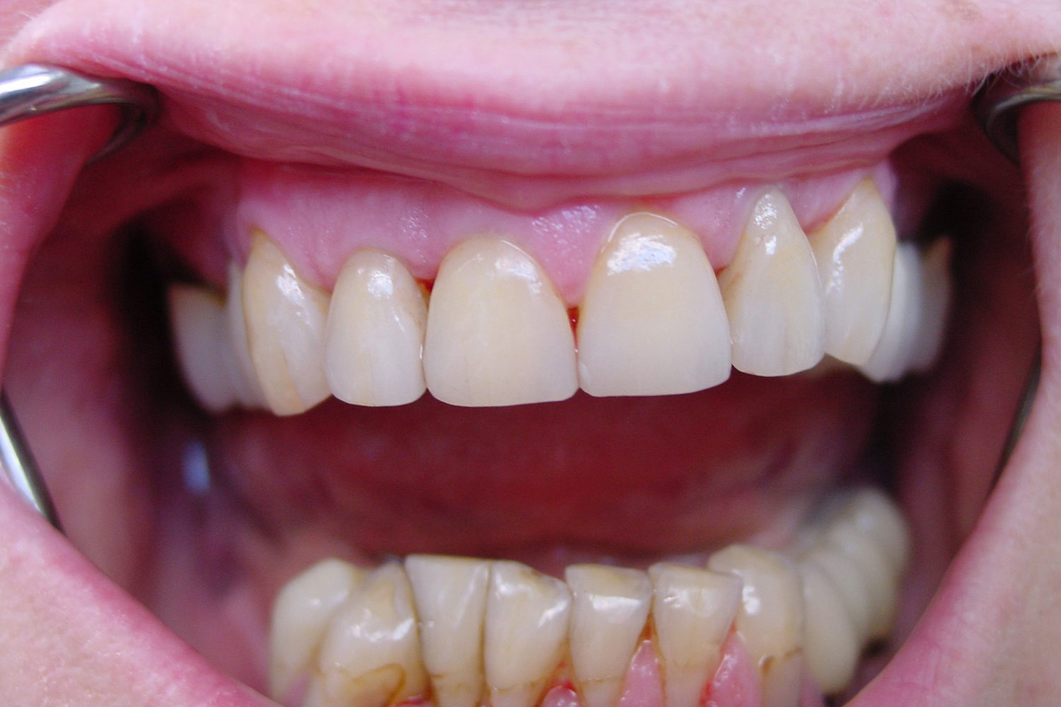 Prothèses traditionnelles facettes céramiques