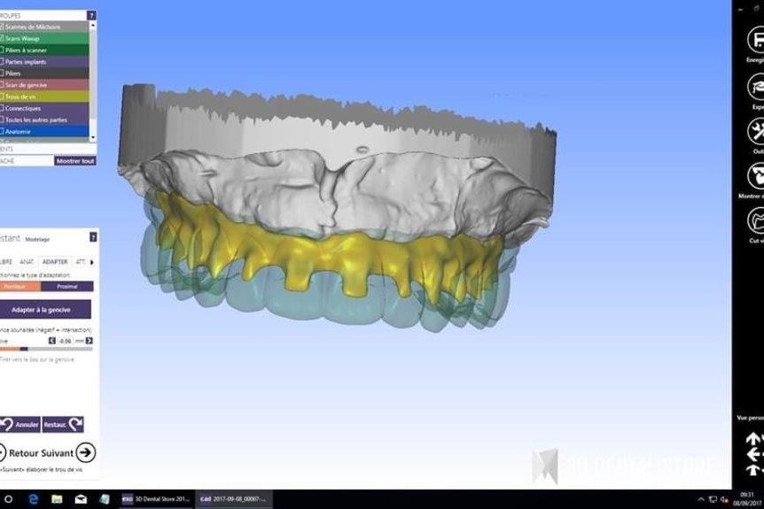 Restauration transvissee plurale