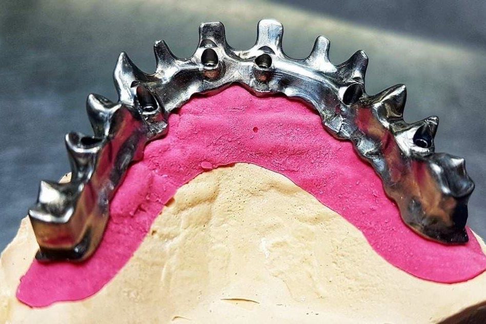 Restauration transvissee plurale